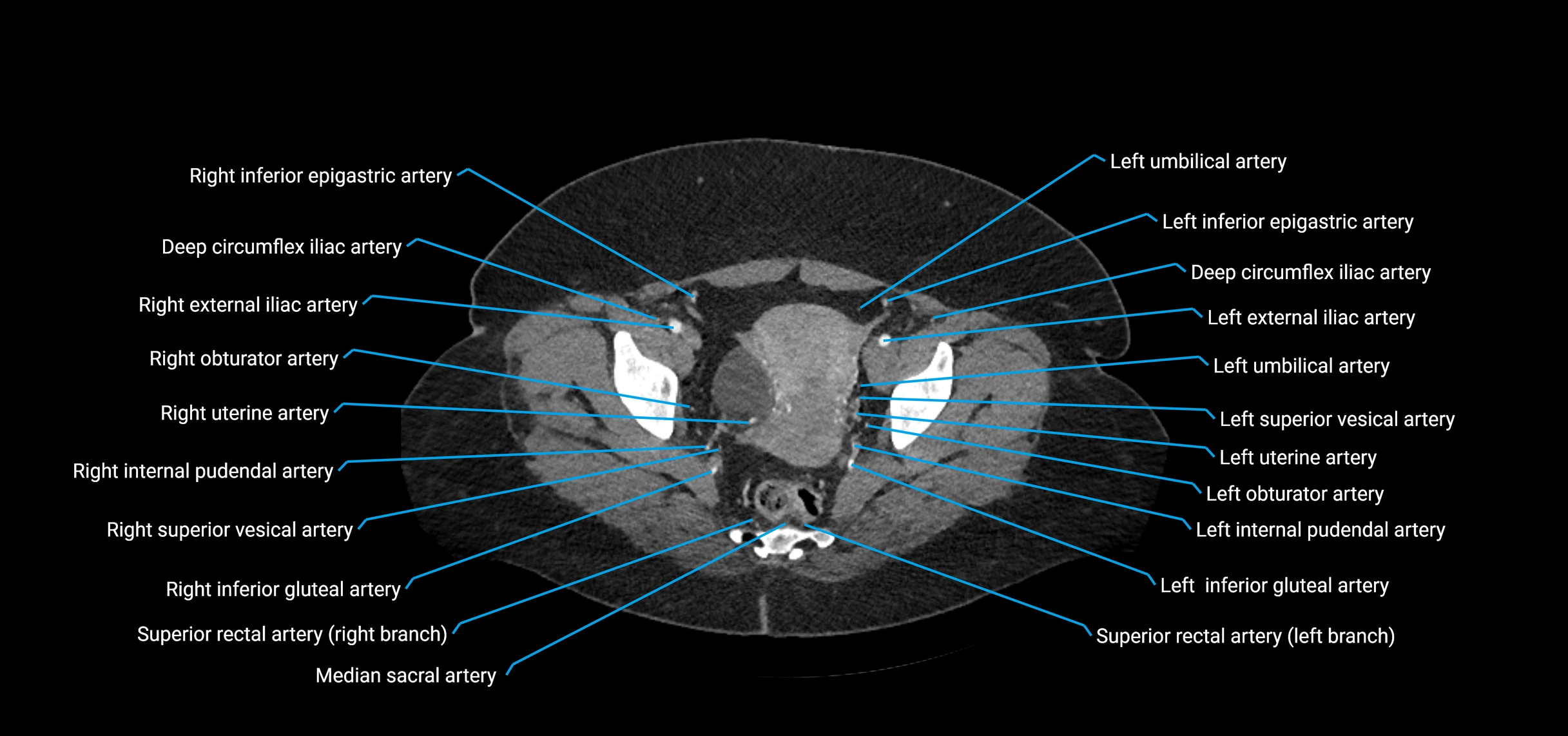CTA abdomen axial cross sectional anatomy labelled image_225 (2).webp